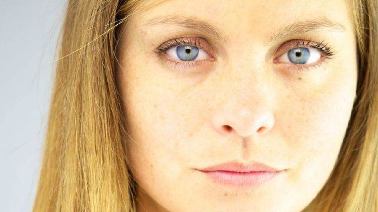 Эмма Мендельсон игнорировала пожелтение кожи и столкнулась с отказом печени Девушка проигнорировала изменение цвета кожи и ...