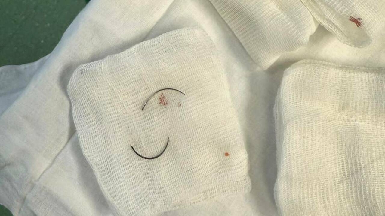 Изначально на КТ была видна только одна игла