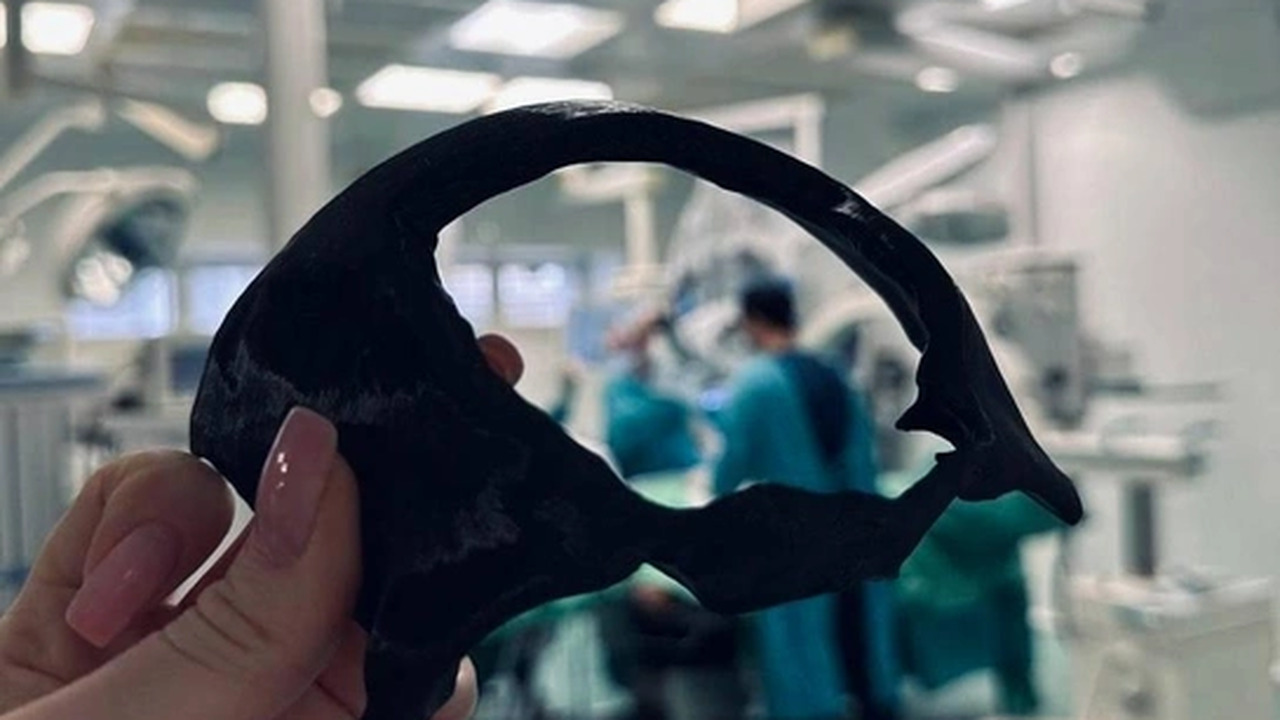 В Казани бойцу СВО воссоздали череп с помощью 3D-печати Врачи Казани с помощью 3D-печати реконструирова...
