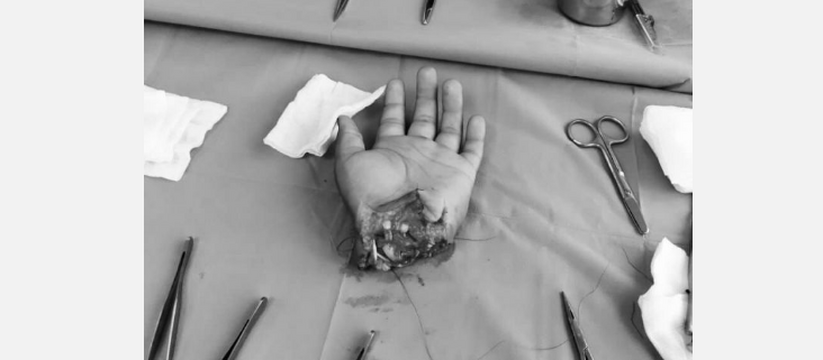 Врачи в Татарстане пришили подростку руку, отрубленную топором